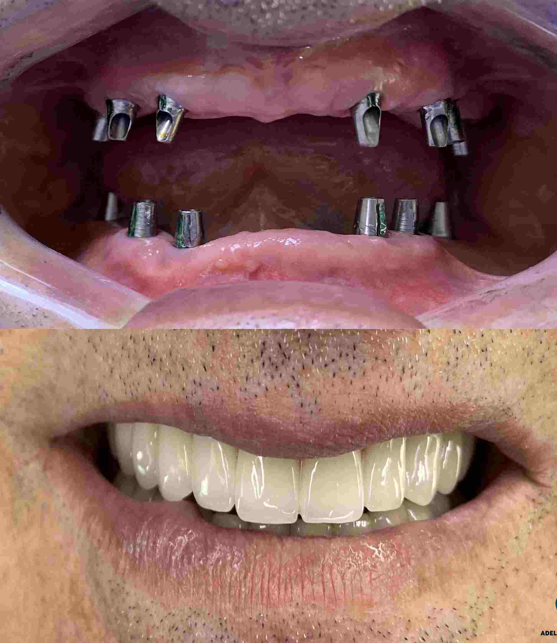 allonsix-dental-implants