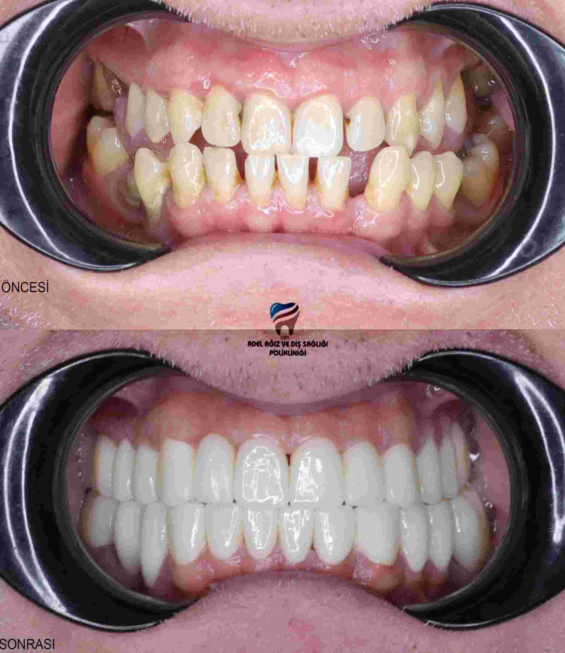 dental-implants-zirconium-crowns-veneers