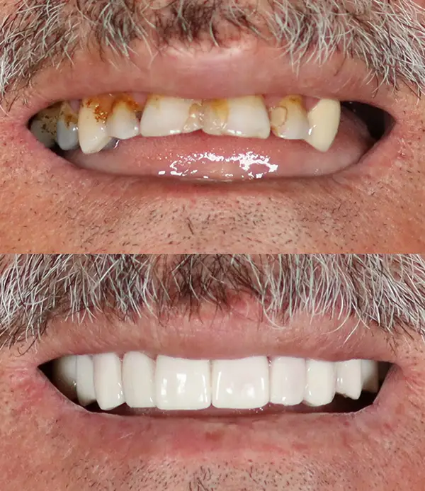 porcelain crowns-veneers