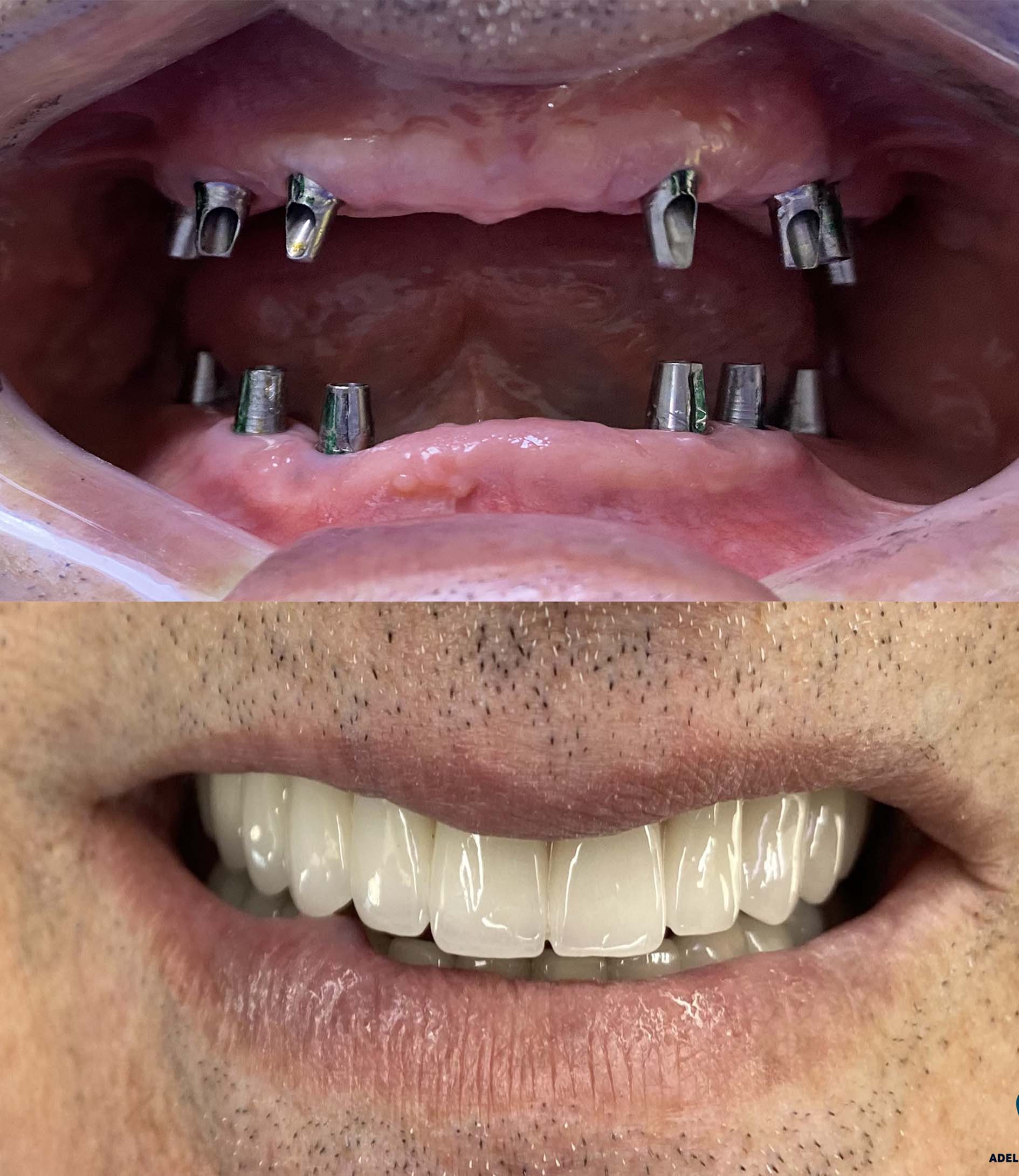 allonsix-dental-implants