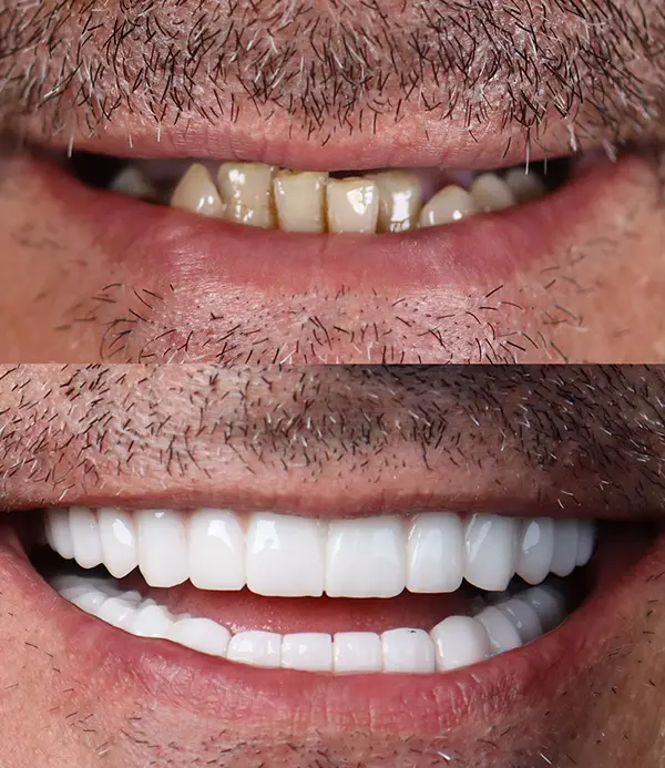 Zirconium-crowns-veneers