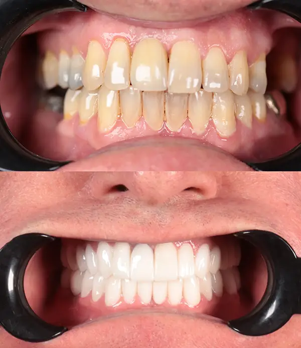 Zirconium-crowns-veneers