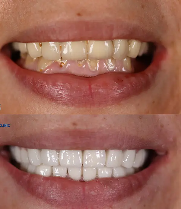 porcelain-crowns-veneers