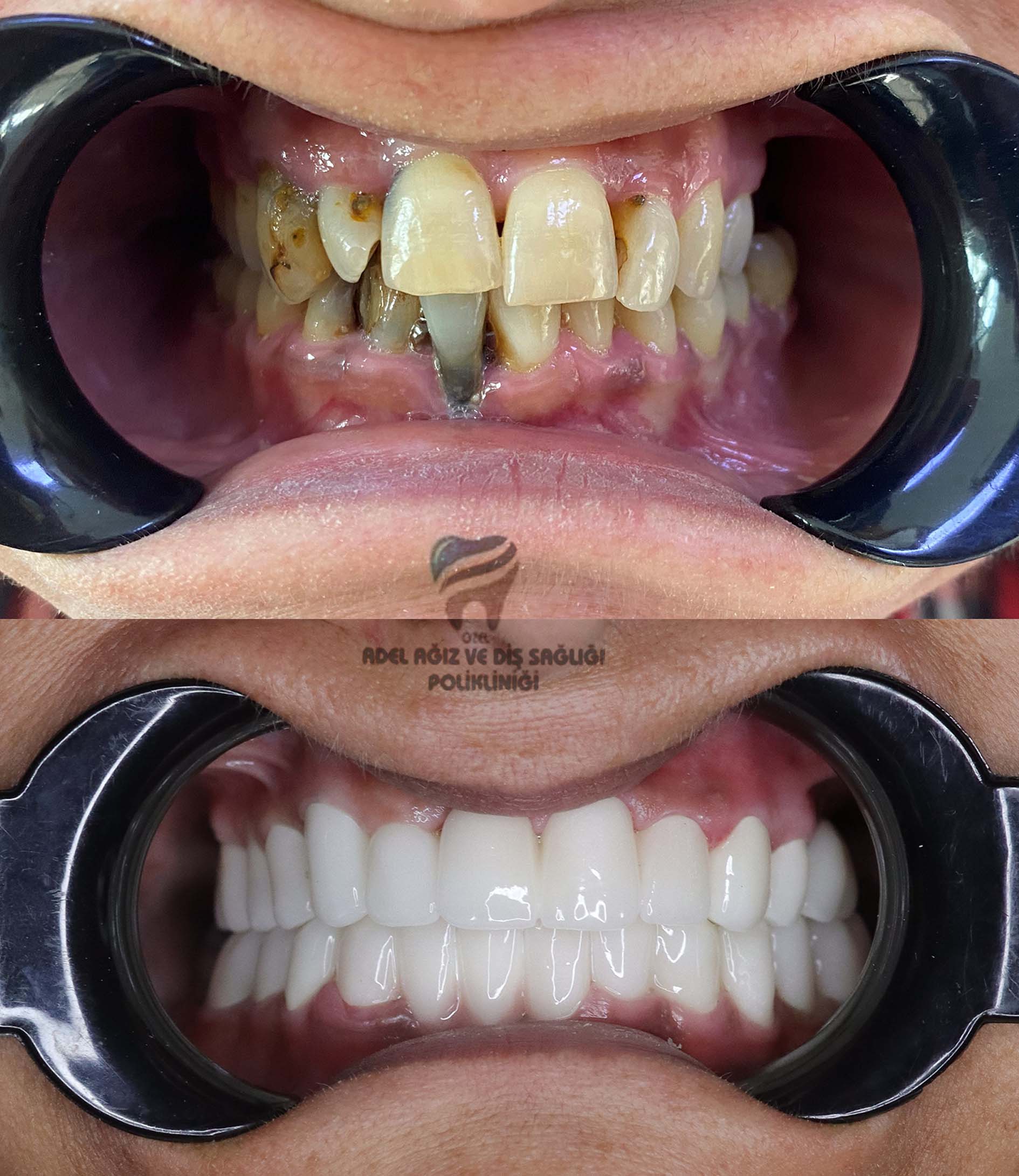 porcelain-crowns-veneers-dental-implants
