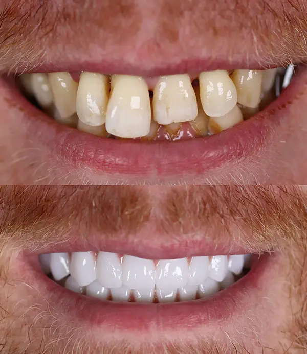 porcelain-crowns-veneers-dental-implants