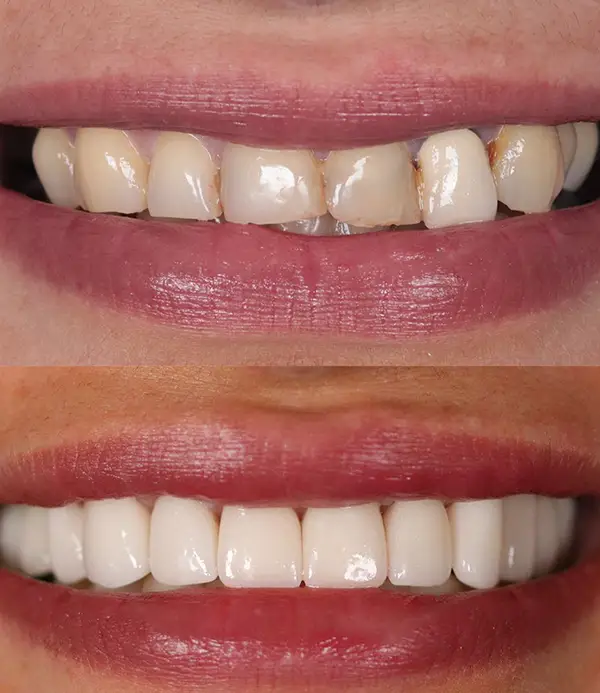 Zirconium-crowns-veneers