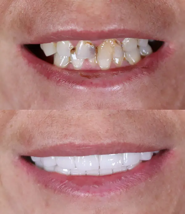 porcelain-crowns-veneers