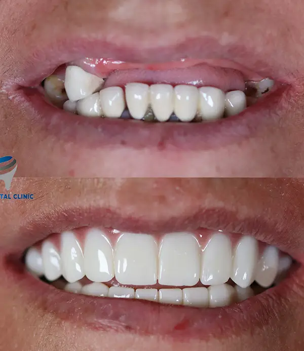 Zirconium-crowns-veneers