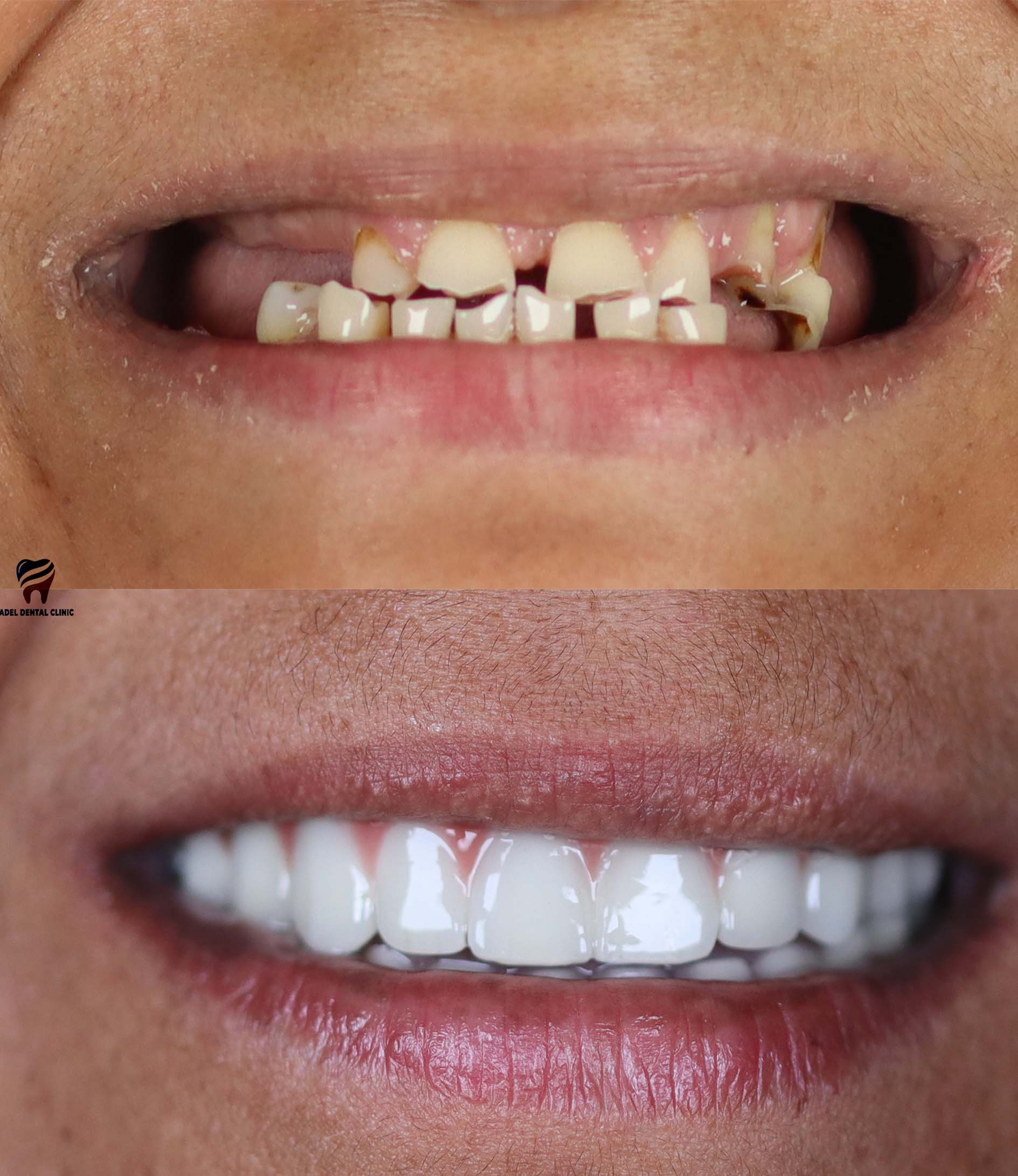 porcelain-crowns-veneers-dental-implants