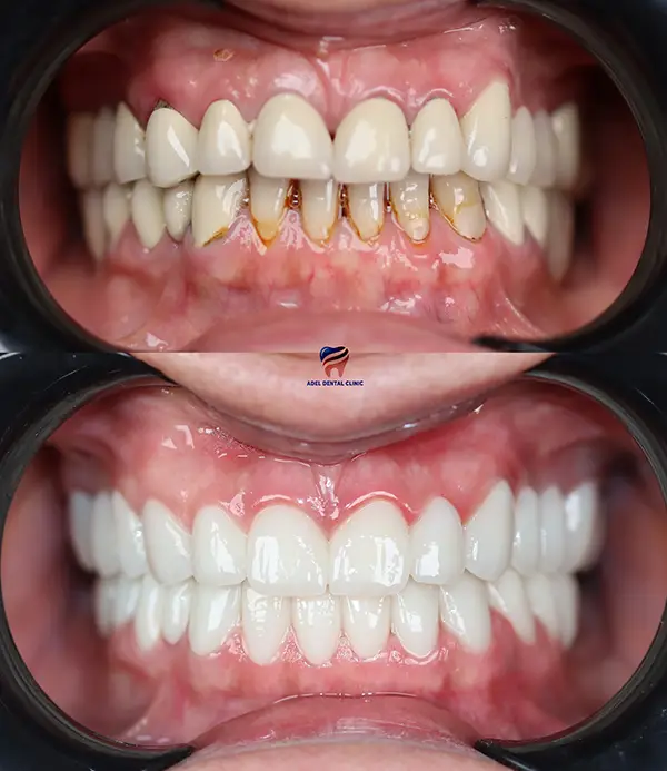 porcelain crowns-veneers