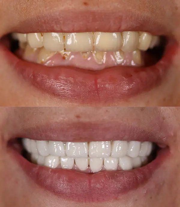 porcelain crowns-veneers