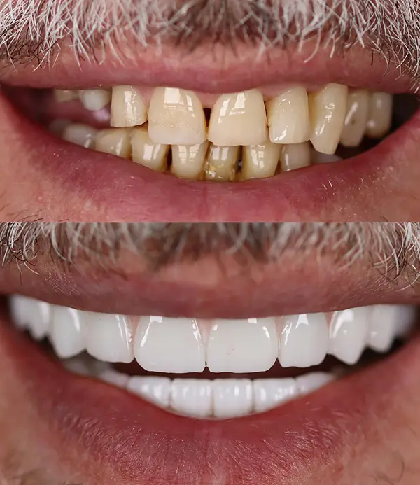 porcelain crowns-veneers