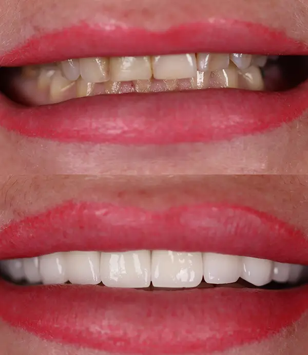 porcelain crowns-veneers