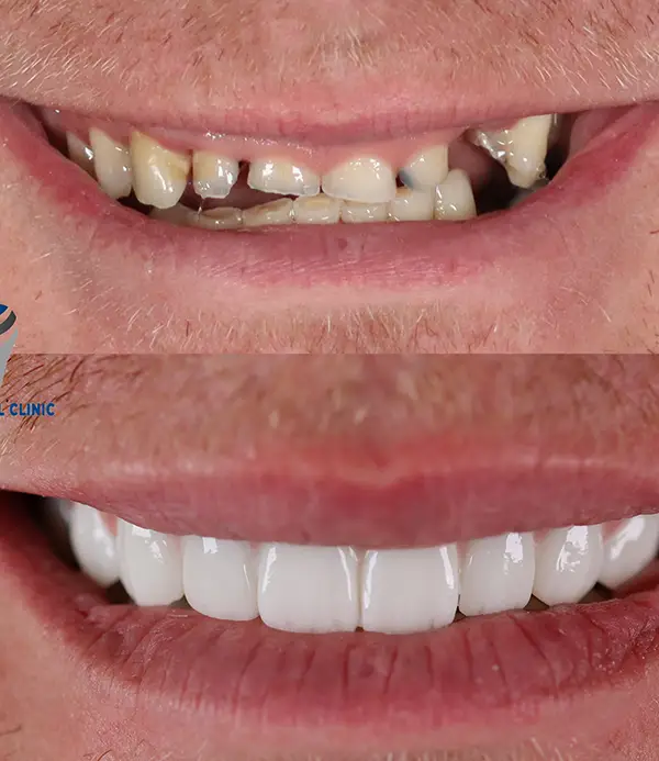 porcelain crowns-veneers