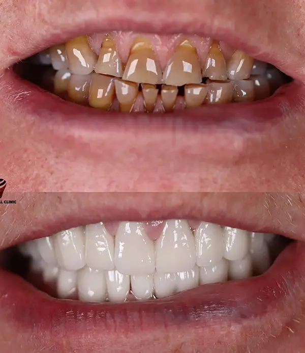 porcelain crowns-veneers