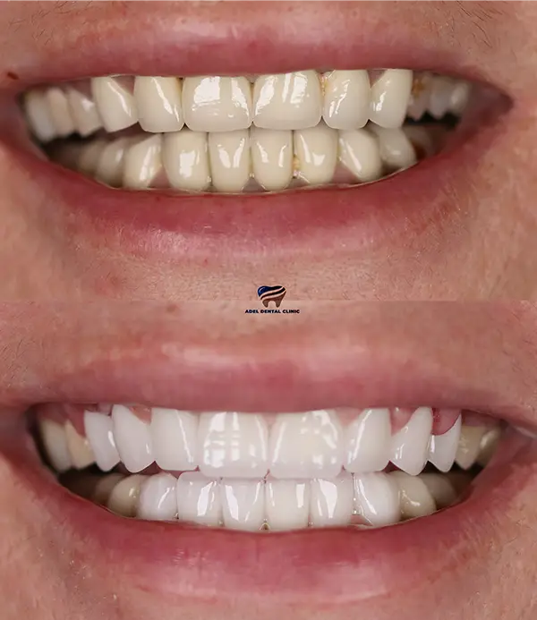 porcelain crowns-veneers