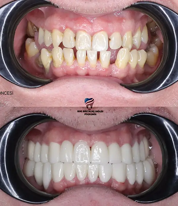 porcelain crowns-veneers