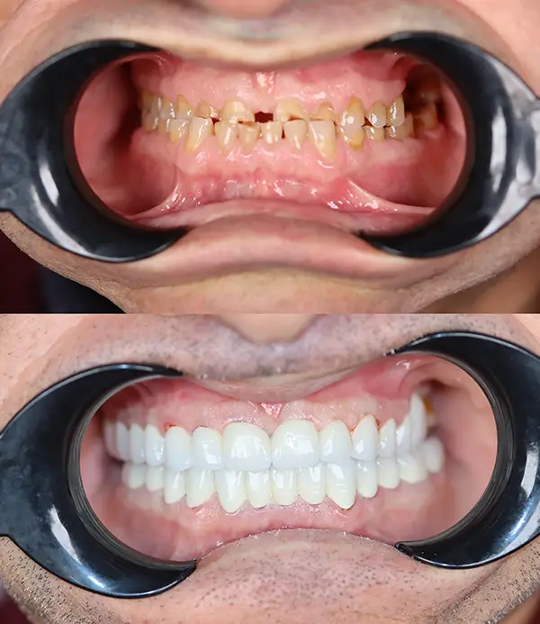 porcelain crowns-veneers