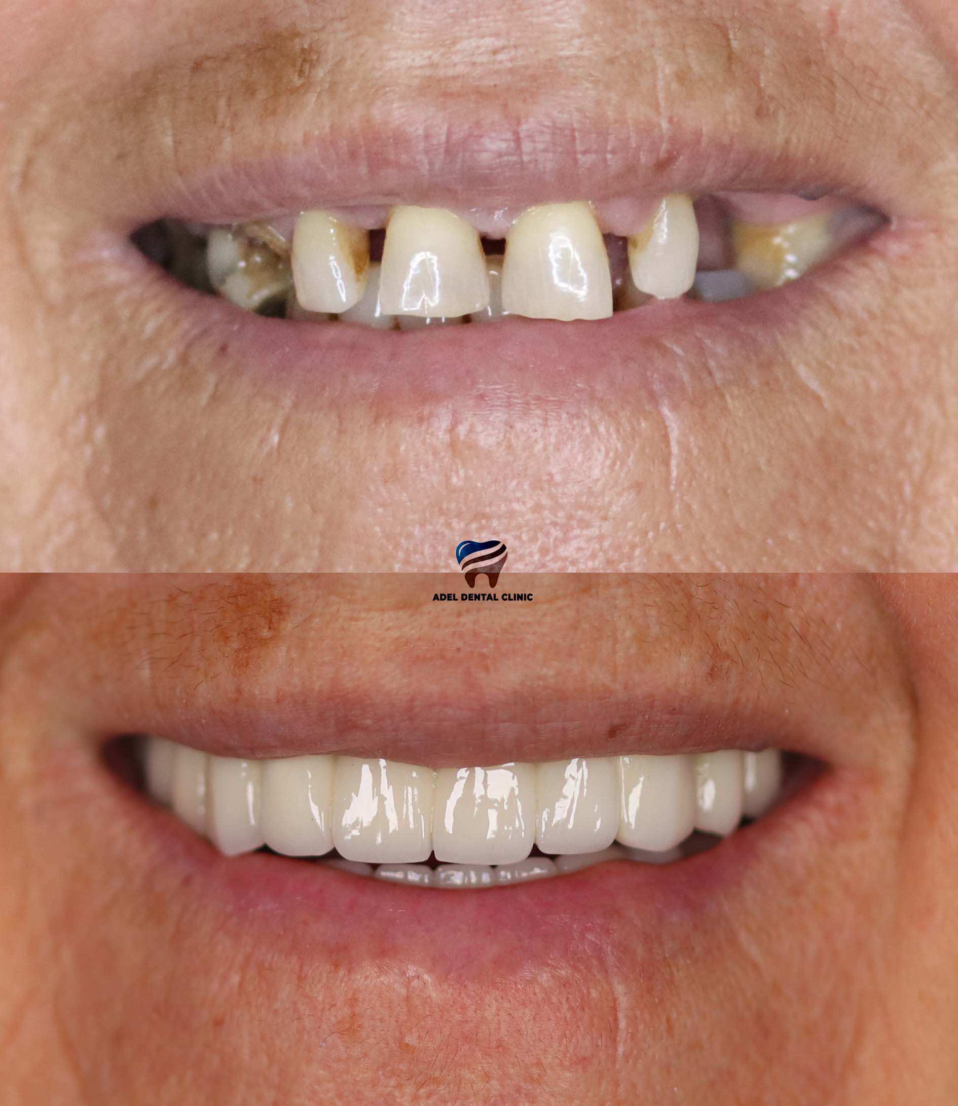 dental-implants-laminate-veneers