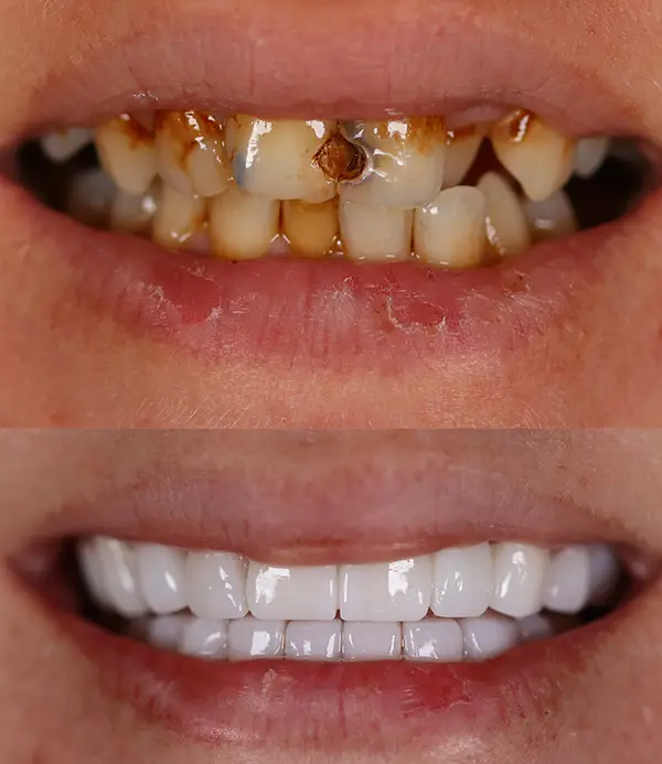 porcelain crowns-veneers