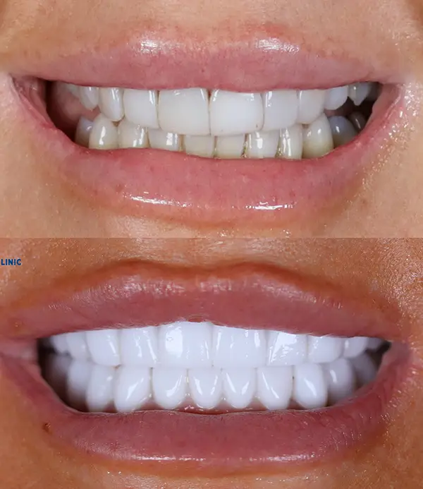 porcelain crowns-veneers