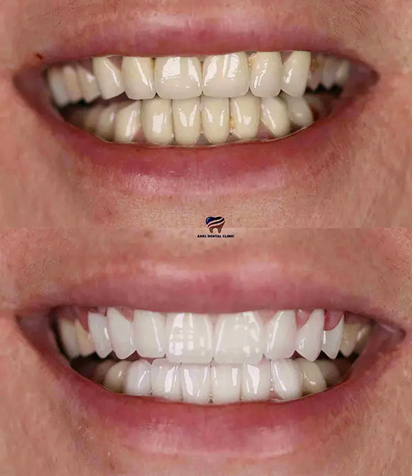 porcelain crowns-veneers