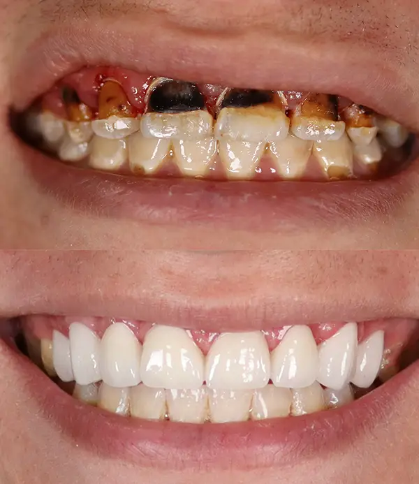 porcelain-crowns-veneers