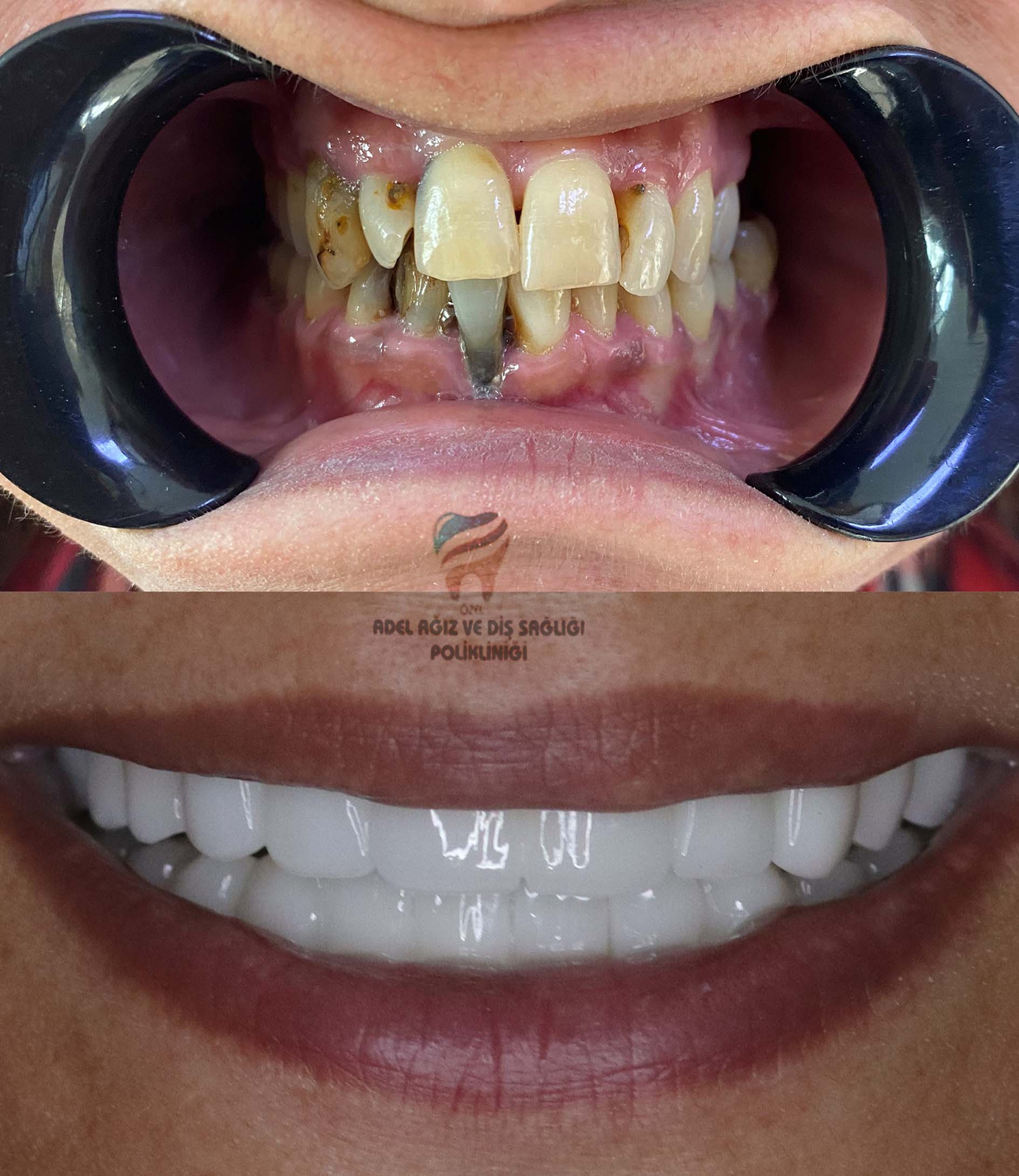 dental-implants-zirconium-crowns-veneers