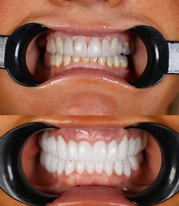 dental-implants-zirconium-crowns-veneers