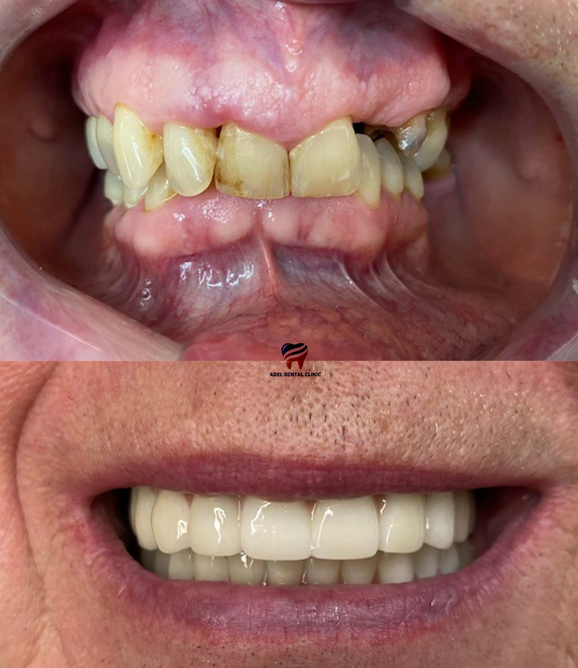 dental-implants-porcelain-crowns-veneers