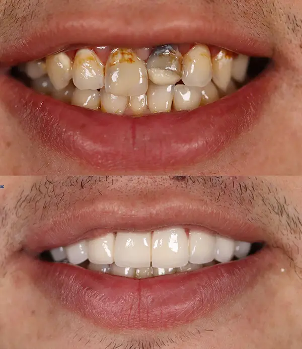 dental-implants-porcelain-crowns-veneers