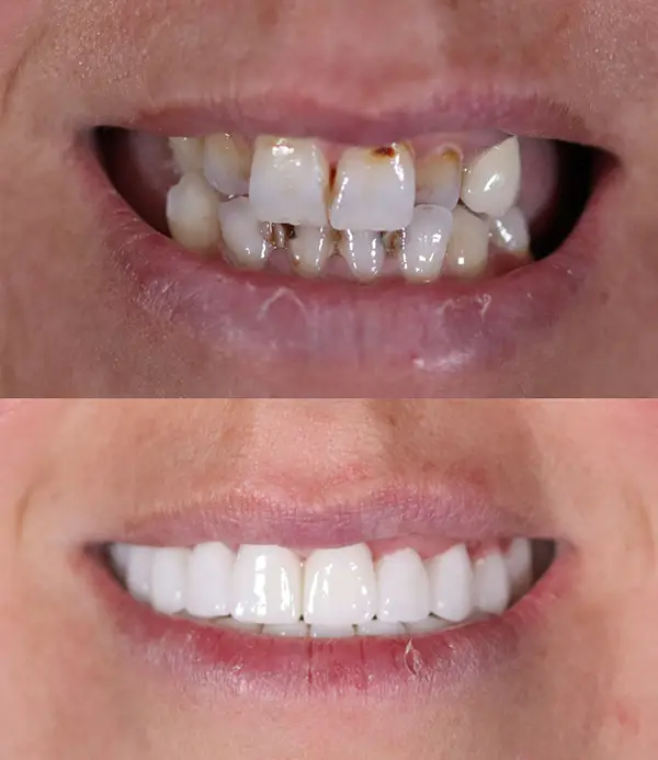 dental-implants-zirconium-crowns-veneers