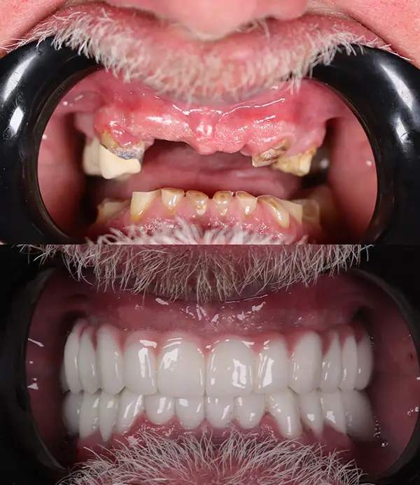 Zirconium-crowns-veneers