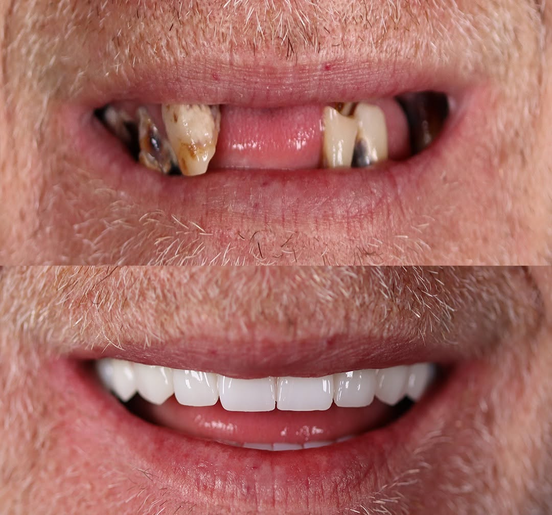 adeldentalclinic before-after-1 in Antalya Turkey in Antalya Turkey