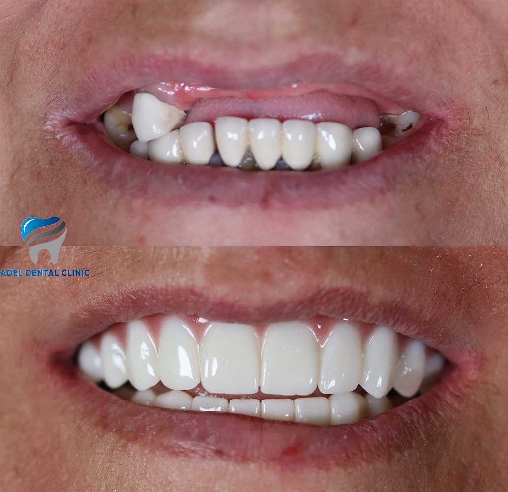 adeldentalclinic before-after-2 in Antalya Turkey