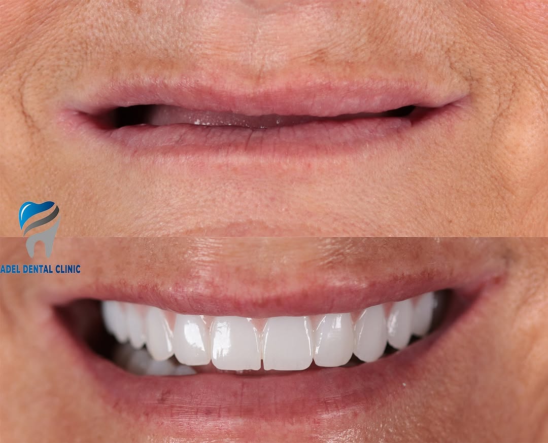 adeldentalclinic before-after-3 in Antalya Turkey