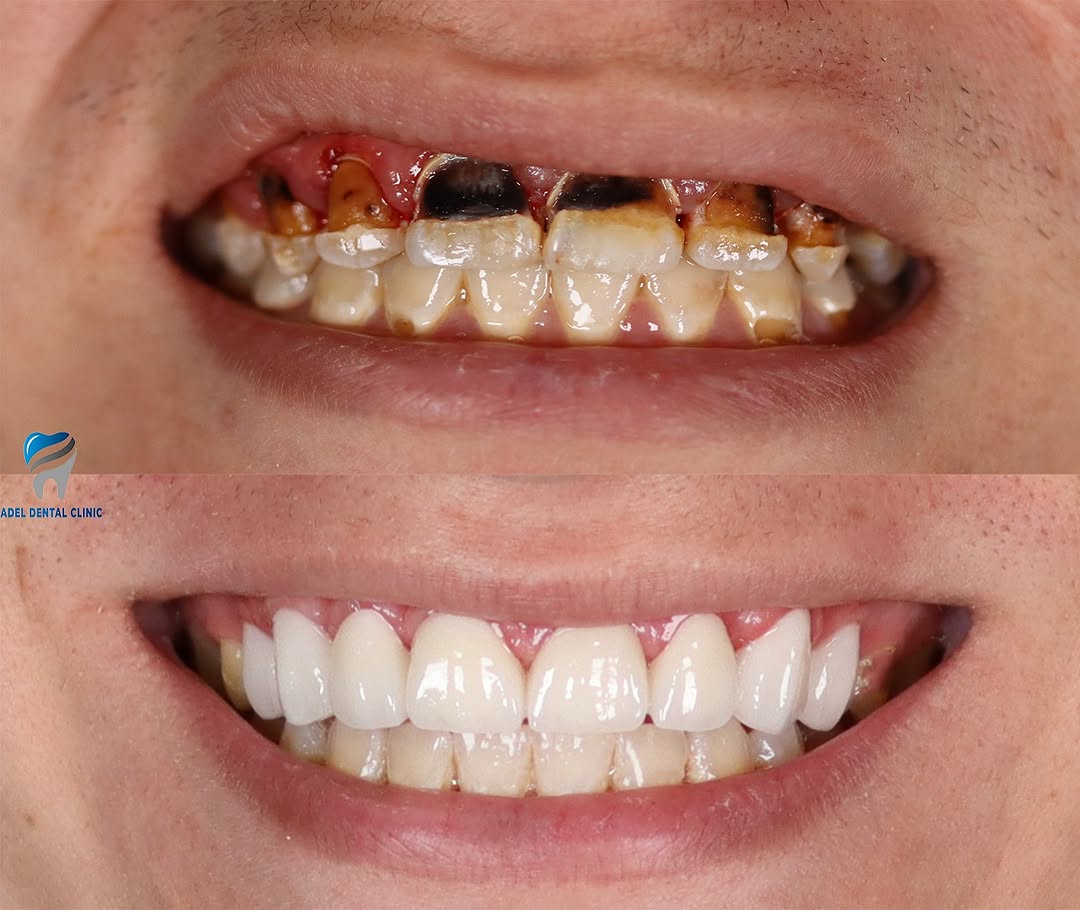 adeldentalclinic before-after-4 in Antalya Turkey