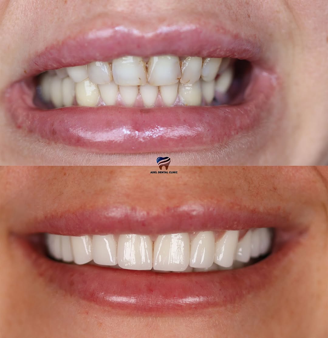 adeldentalclinic before-after-5 in Antalya Turkey