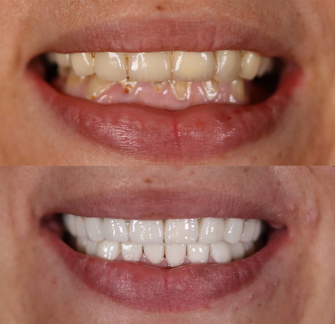 adeldentalclinic before-after-6 in Antalya Turkey