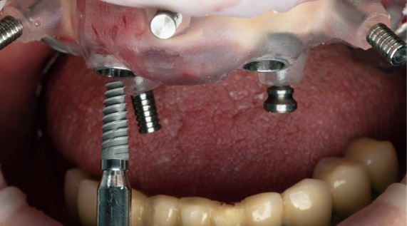 what-is-the-failure-rate-of-all-on-6-dental-implants-turkey