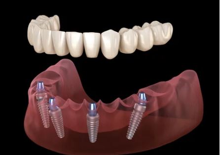 Is it safe to have all on four dental implants done in Turkey?