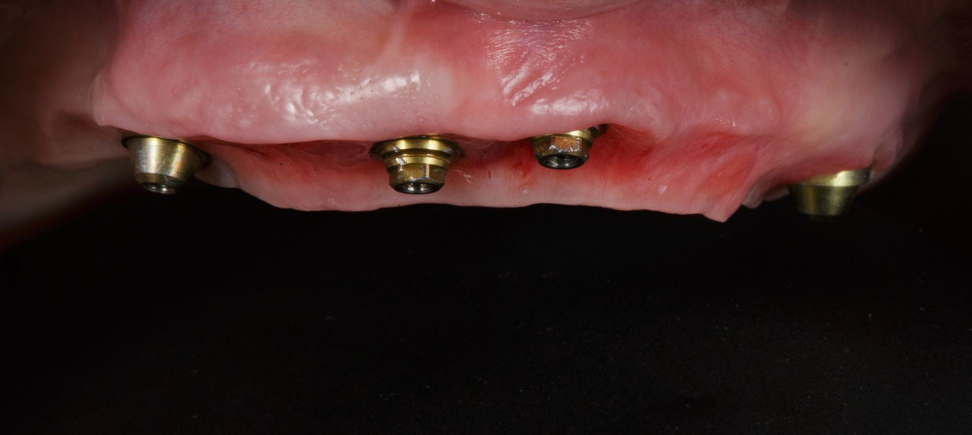 How painful is All-on-4 dental implants?-turkey-antalya