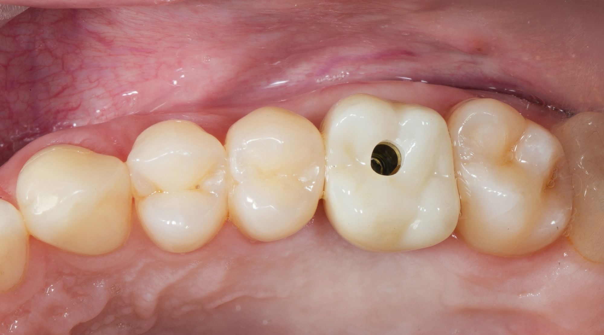 Do all on 4 dental implants look real?-turkey-antalya