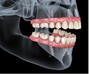 Do All on 4 dental implants feel like real teeth? in Turkey?