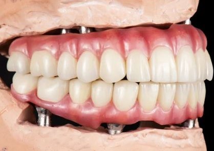 How Long Do All on 4 Dental Implants Last? in Turkey, Antalya 
