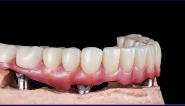 what-are-the-steps-to-all-on-4-dental-implants-turkey