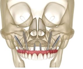 What to Do & not to Do Before All on Six Dental Implants Surgery? in turkey, antalya