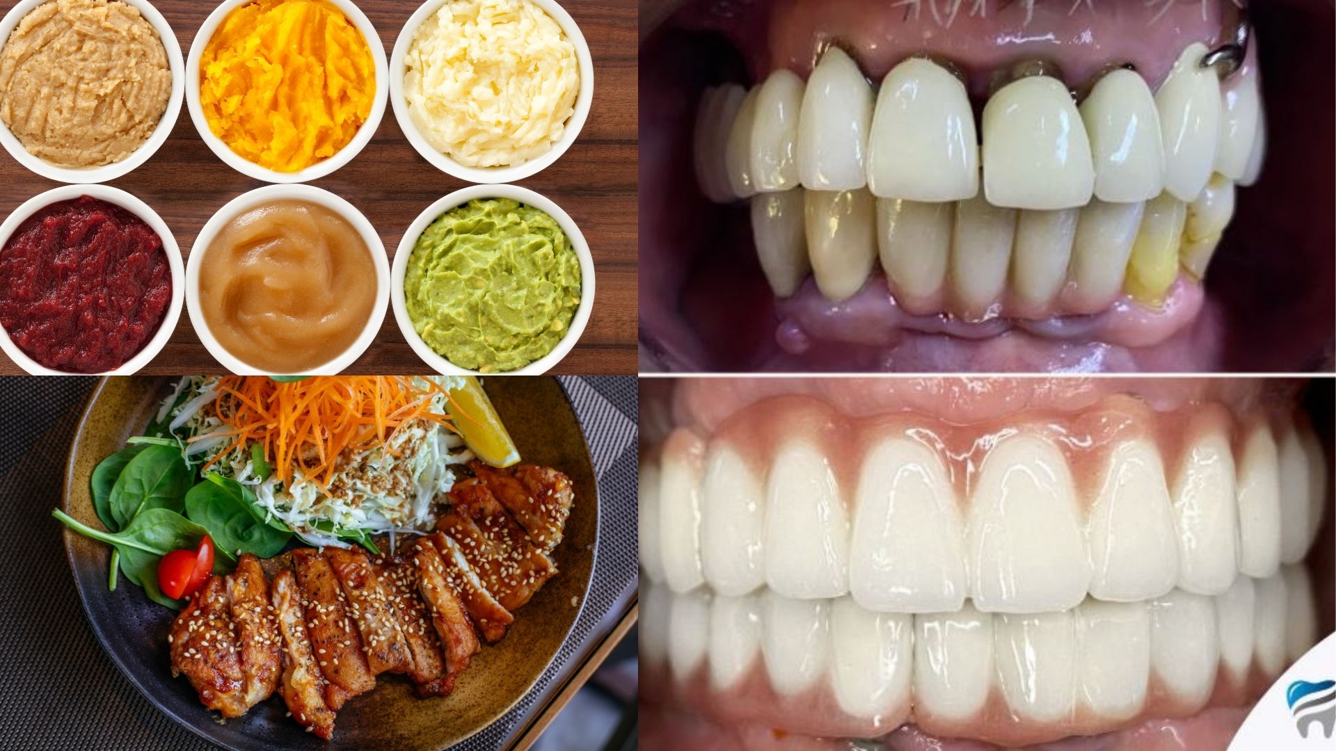 what-to-eat-after-all-on-6-dental-implants-turkey