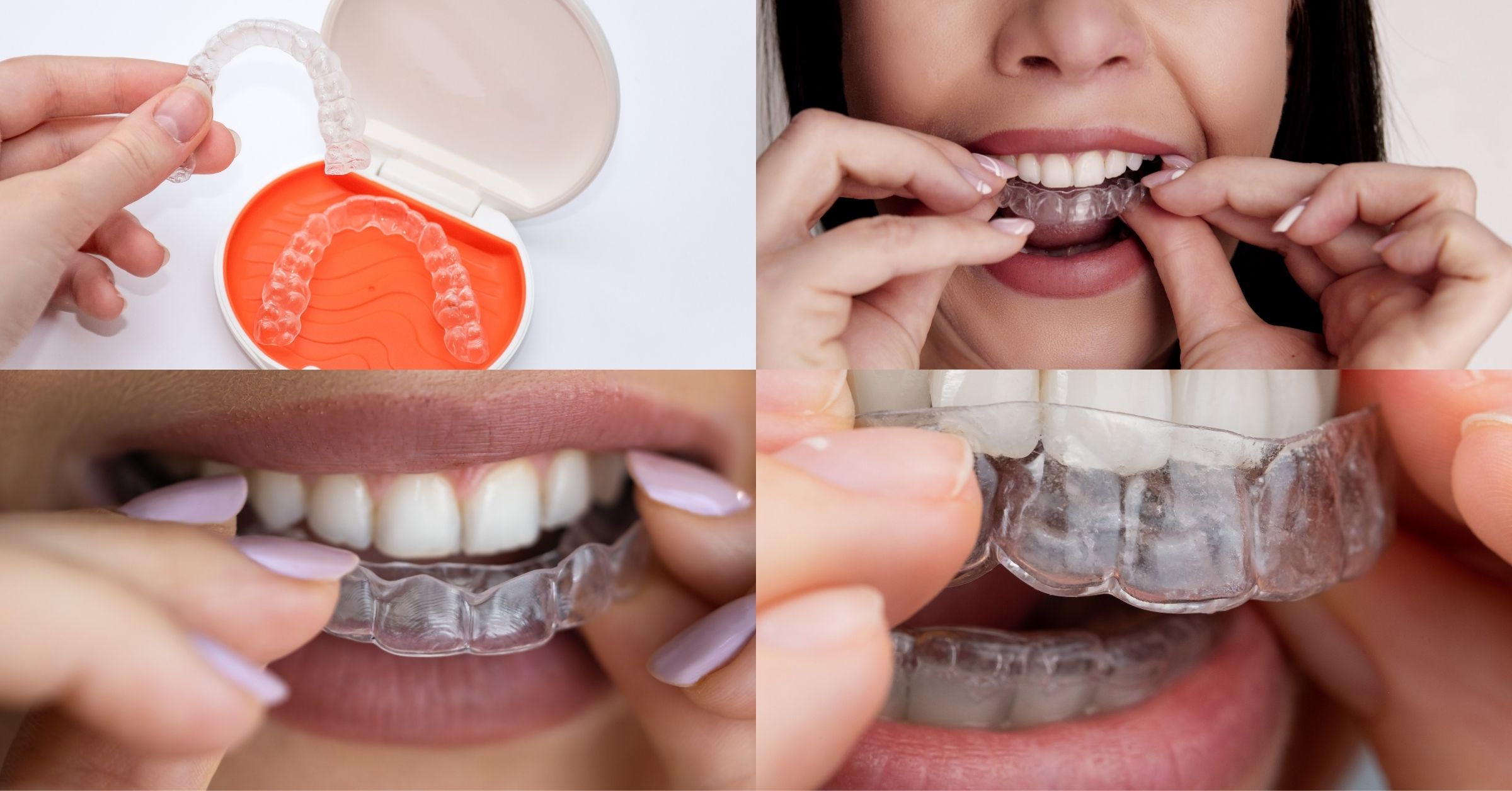 Inserting and Removing Invisalign / Clear Aligners in Antalya Turkey