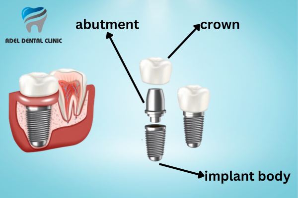 dental-implant-parts-antalya